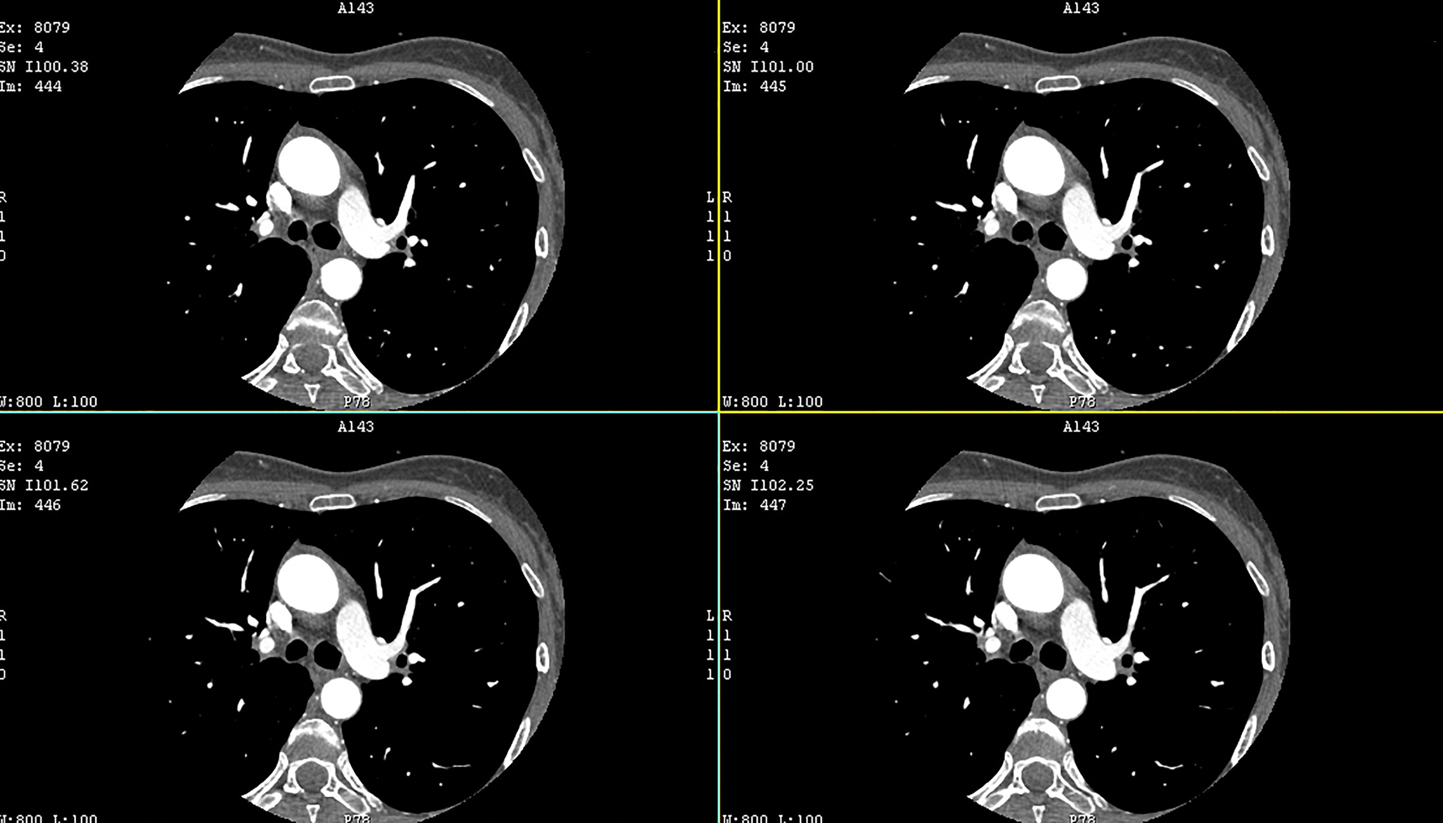 CT Cardiac Images