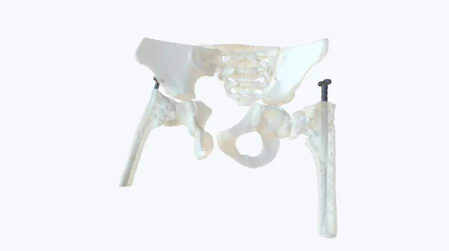 Osteogenesis imperfecta  on the hips - Ortho