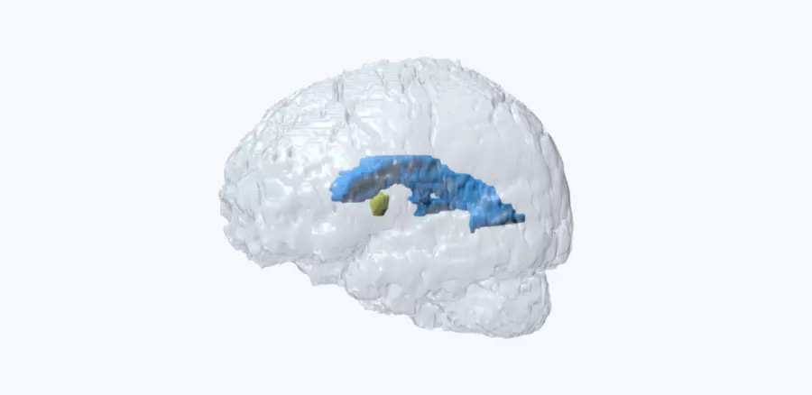 Colloid cyst in the brain - Neuro case