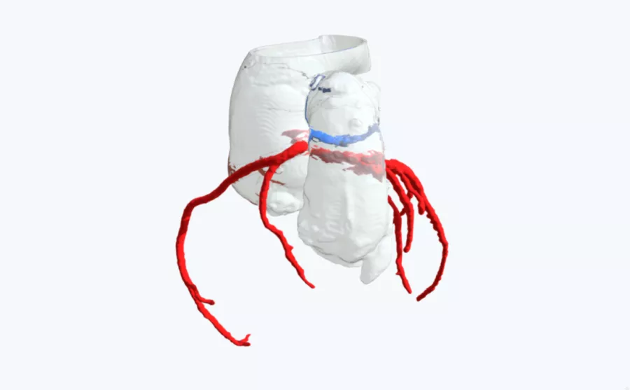 Pulmonary atresia with ventricular septal defect- Cardiology