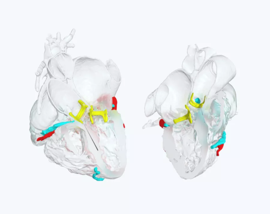 Heart model for Cardiac surgery planning