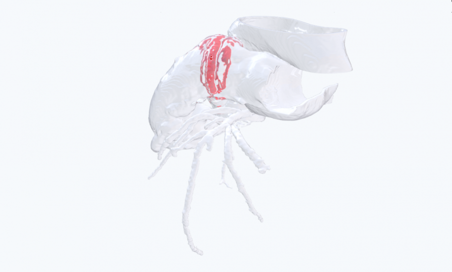 3D cardiac model supports Hancock valve replacement