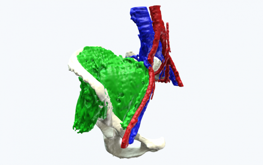 3D printed pelvis & tumor model