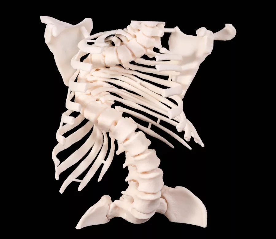 Scoliosis spine with logo