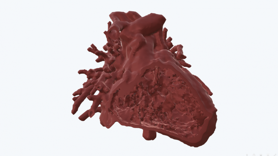 VSDs paediatric heart - Cardio case