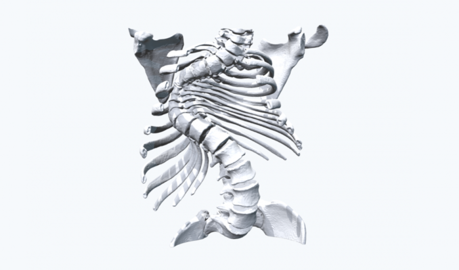 Severe Scoliosis anatomical spine model