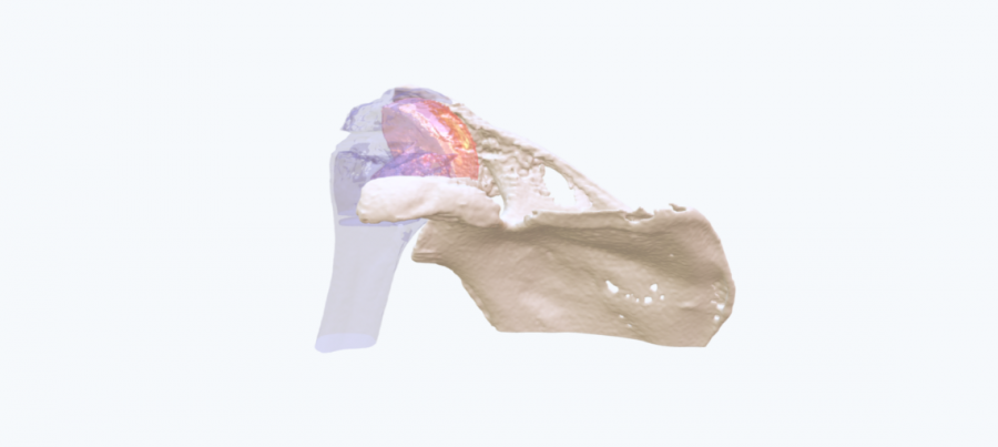 Glenoid cavity pathology in left shoulder - Ortho case