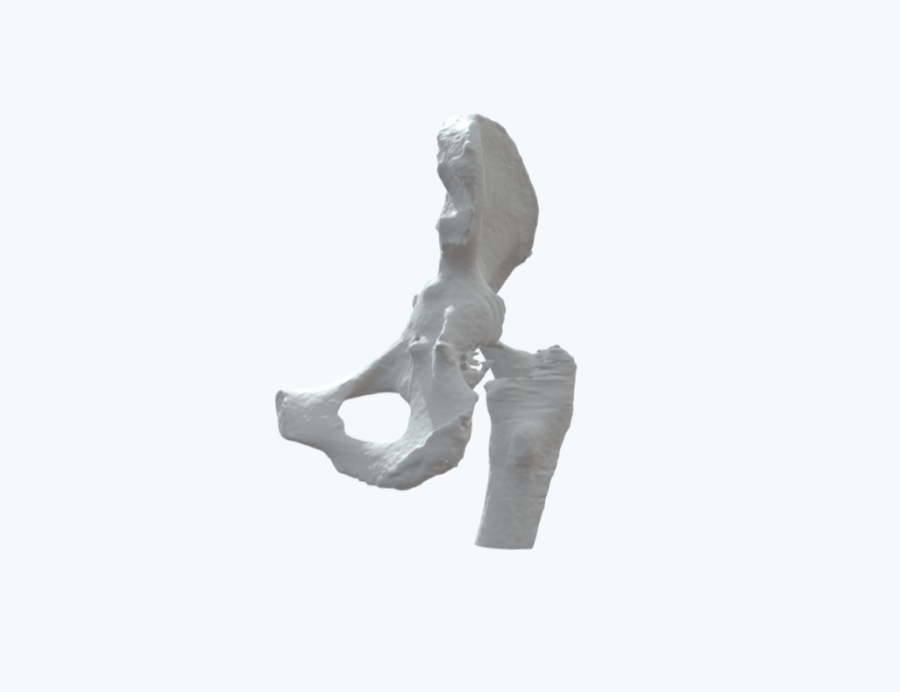 Complex acetabular defects of the pelvis - Ortho case