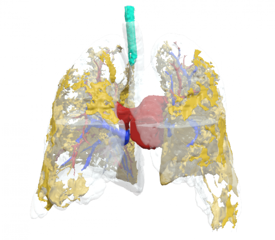 Anatomical model of Covid lungs