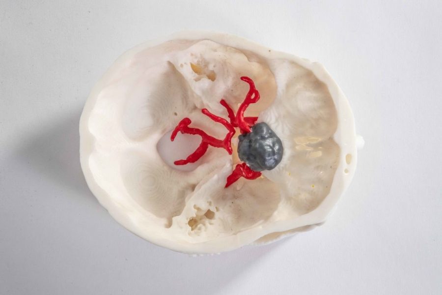 Skull with meningioma tumor - Neuro case