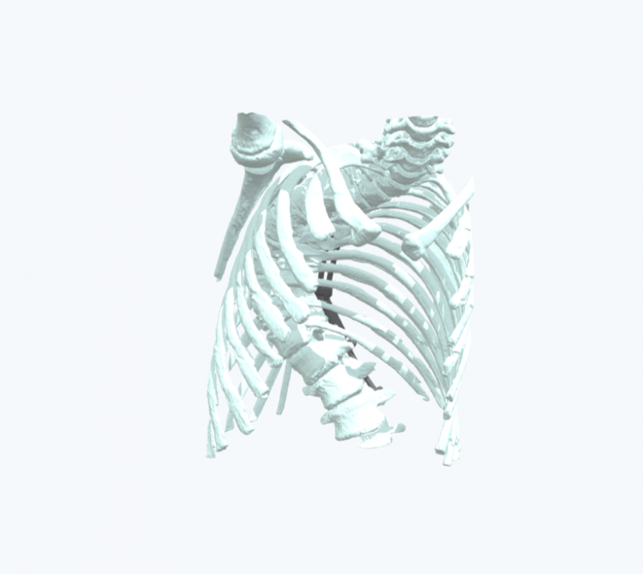 3d anatomical model for scoliosis surgery planning