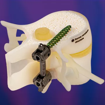 Axial3D.3D-Printed-Models.Spinal-plate-and-skrews-patient-specific-models-for-medical-device-companies-2