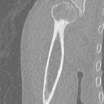 Shoulder scan - Ortho case