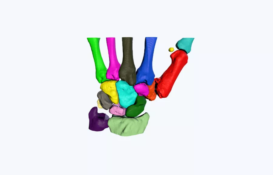 Trapeziectomy-Treatment