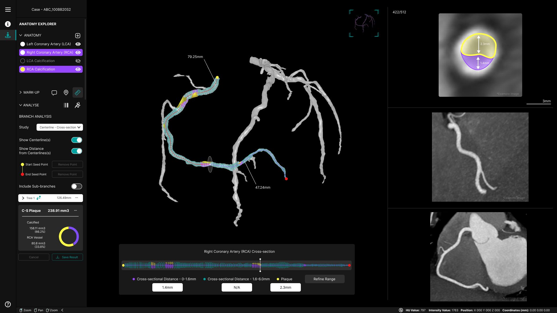 Pre-Surgical Planning