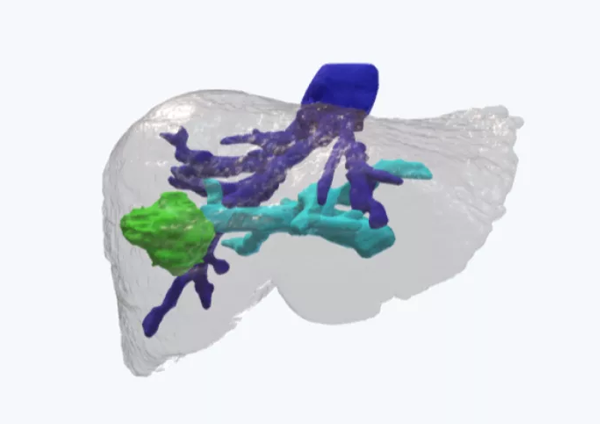 Patient liver and tumor
