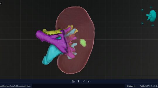 AXCEL_kidney_tumor
