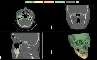 TMJ & Maxillofacial Implants